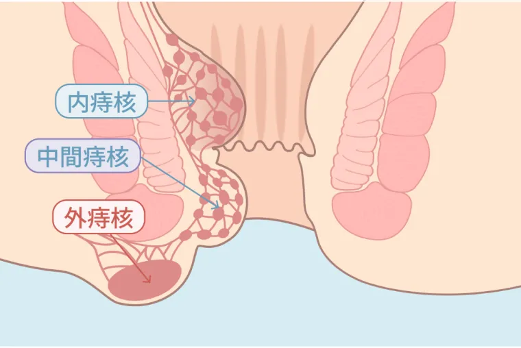 いぼ痔（内痔核・中間痔核・外痔核）の図解