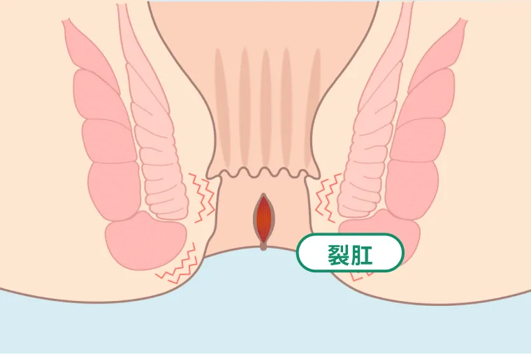 きれ痔（裂肛）の図解