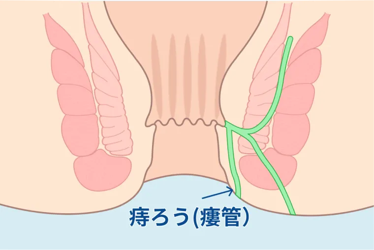 痔ろう（瘻管）の図解