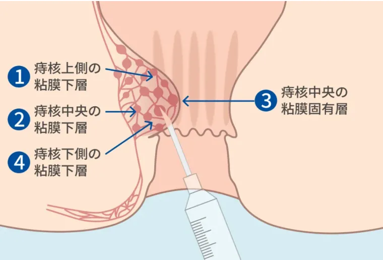 内痔核へのジオン注射の図解
