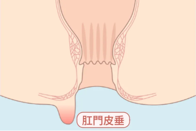 スキンタグ（肛門皮垂）の図解