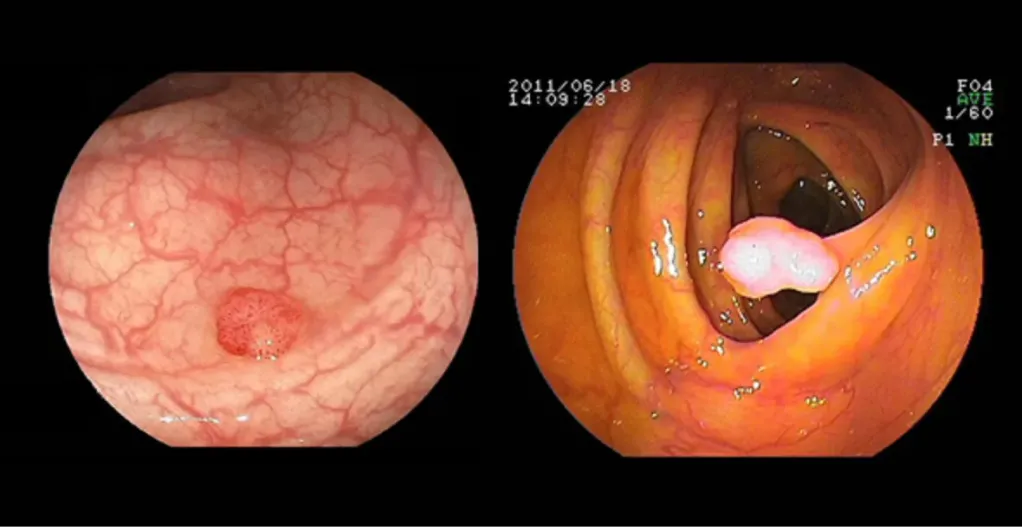 大腸内視鏡の画像