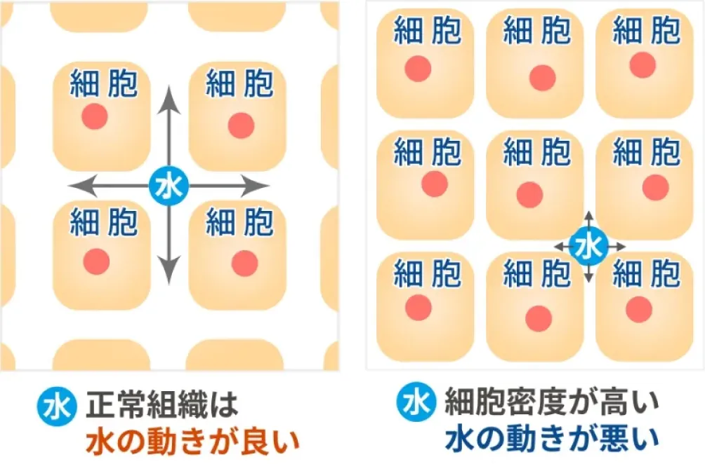 正常組織は水の動きが良い／細胞密度が高いと水の動きが悪い