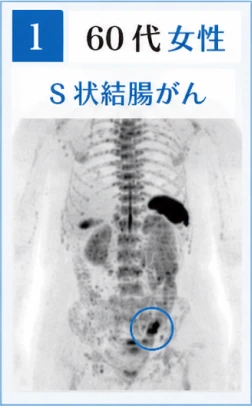 1　60代女性　S状結腸がんのドゥイブス検査画像
