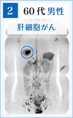 2　60代男性　肝細胞がんのドゥイブス検査画像