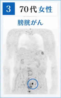 3　70代女性　膀胱がんのドゥイブス検査画像