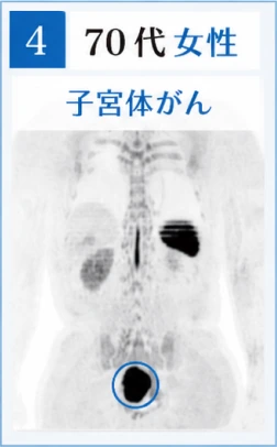 4　70代女性　子宮体がんのドゥイブス検査画像