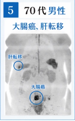 5　70代男性　大腸癌、肝転移のドゥイブス検査画像