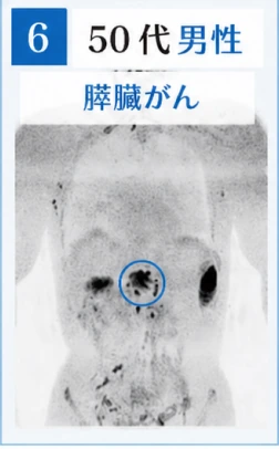 6　50代男性　膵臓がんのドゥイブス検査画像