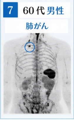 7　60代男性　肺がんのドゥイブス検査画像