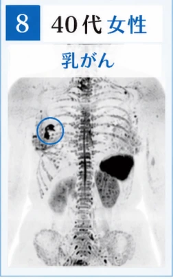 8　40代女性　乳がんのドゥイブス検査画像