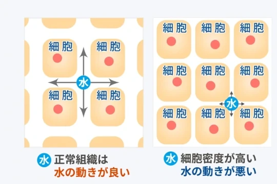正常組織は水の動きが良く、細胞密度が高い部分は水の動きが悪い
