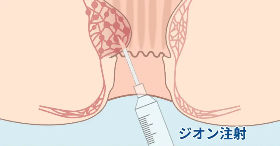 ジオン注射のイラスト