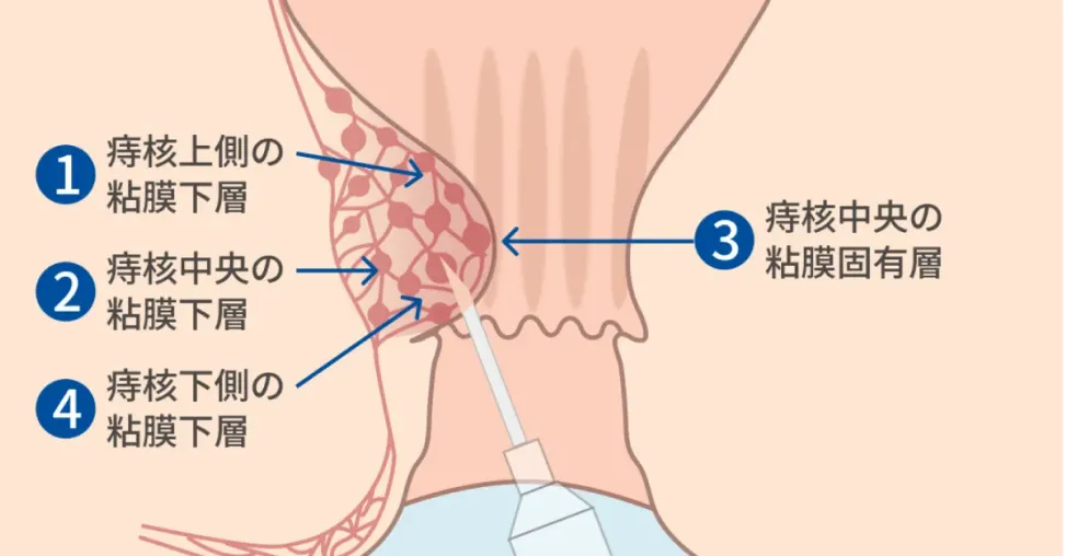 四段階注射法のイラスト