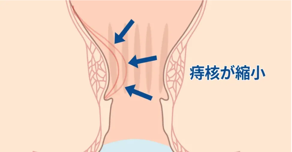 注射後に痔核が縮小する様子のイラスト