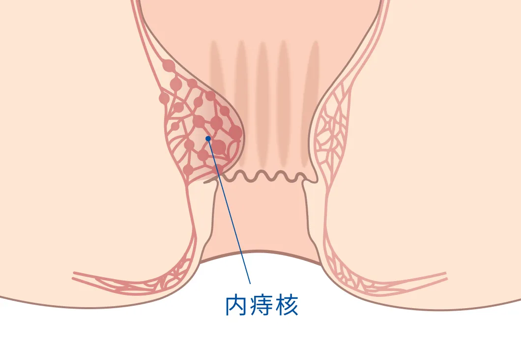 内痔核の位置を示す断面イラスト