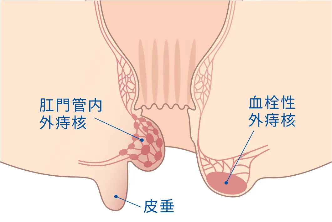 肛門管内外痔核・血栓性外痔核・皮垂の位置を示す断面イラスト