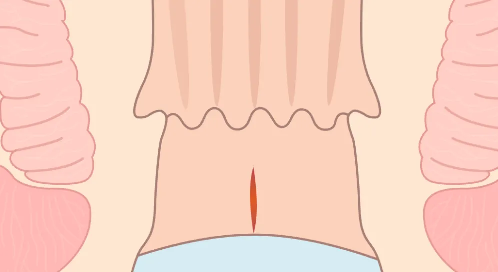 急性裂肛の位置を示す断面イラスト