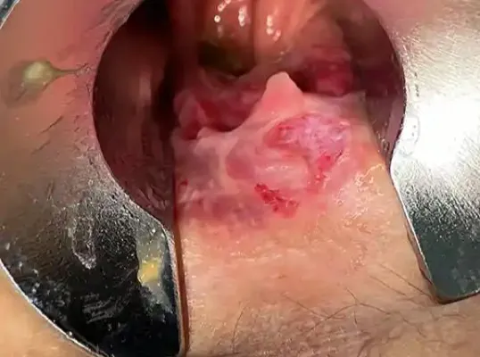 裂肛手術前の症例写真