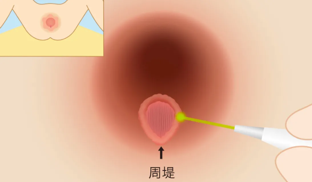 CO2レーザーで周堤を蒸散させるイラスト