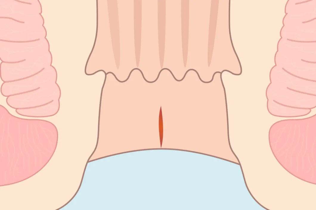 裂肛早期のイラスト