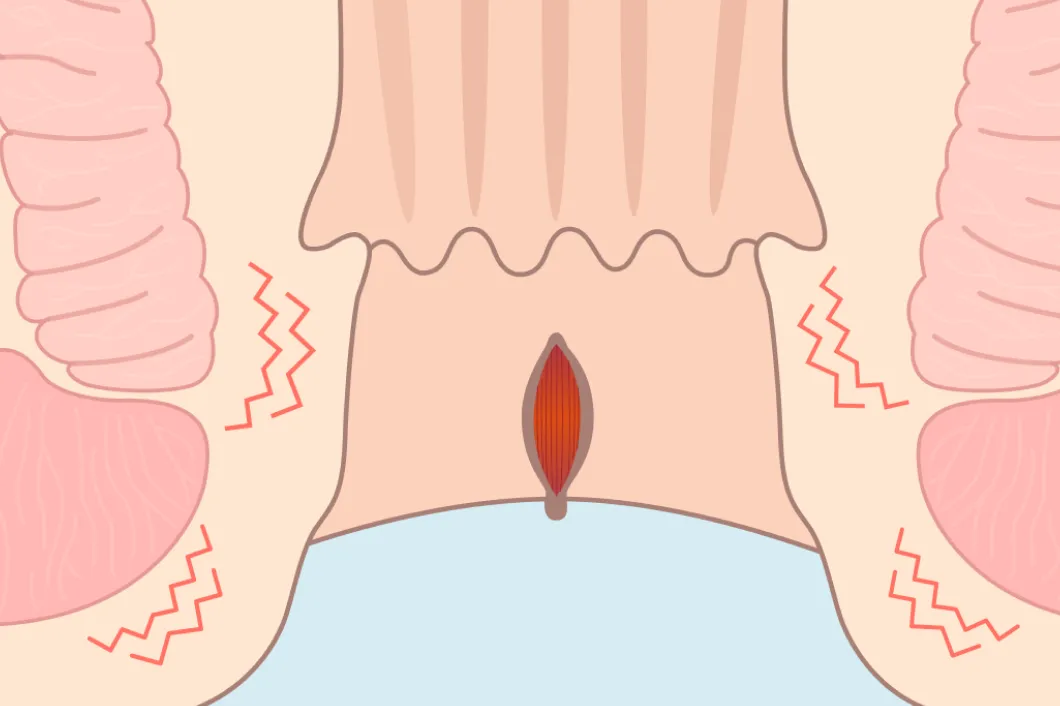裂肛後期のイラスト