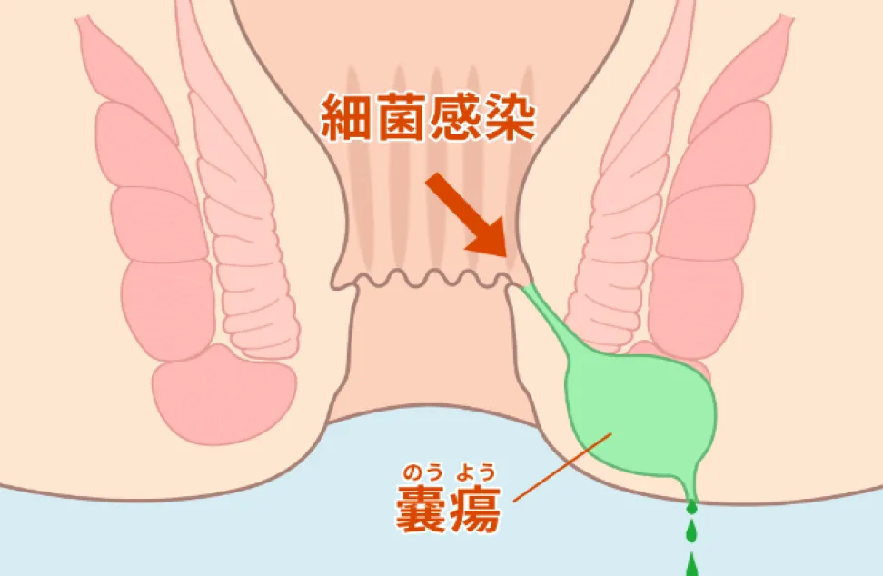 細菌感染から肛門周囲膿瘍ができるまでのイラスト