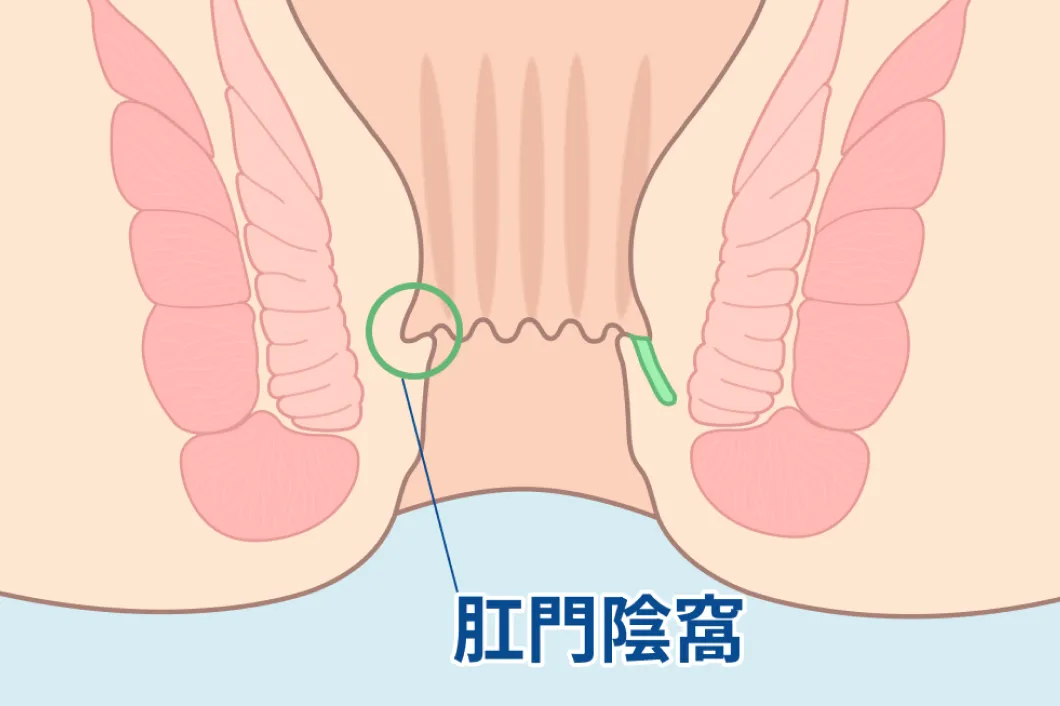初期感染（直腸肛門接合部より感染）のイラスト