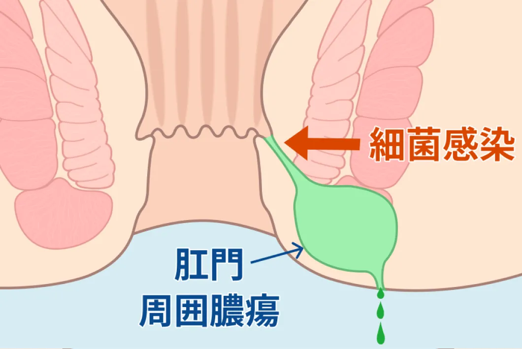 筋間痔ろう（括約筋の間を通る）のイラスト