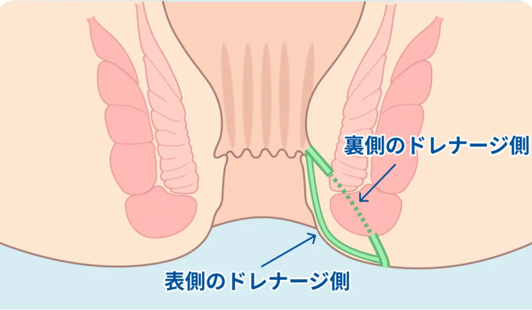 表側・裏側のドレナージ側を示すイラスト