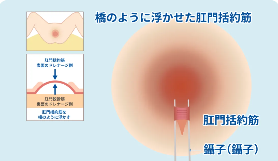 橋のように浮かせた肛門括約筋を示すイラスト