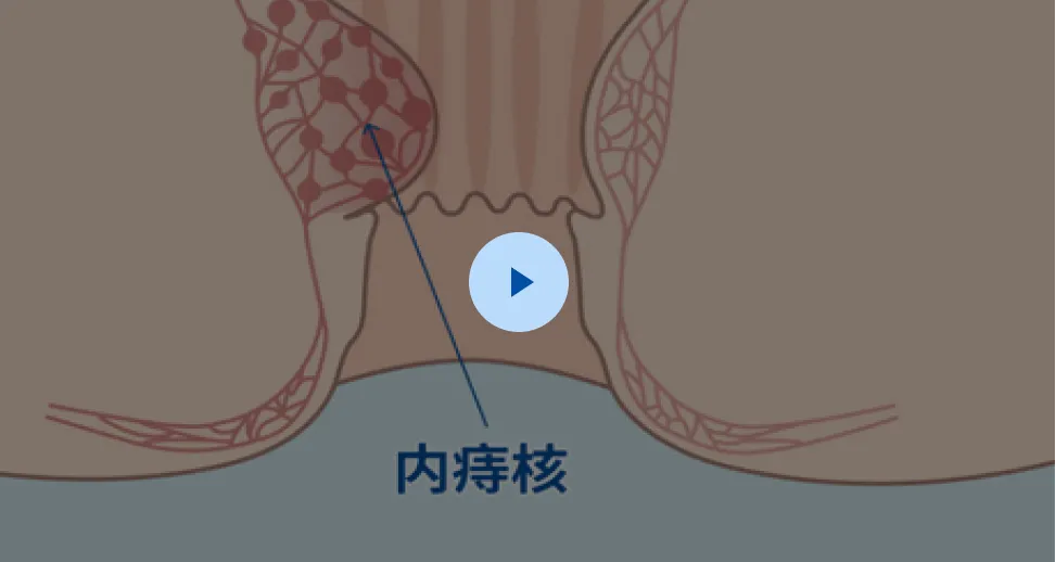 クランプトレーザー法の解説動画イメージ