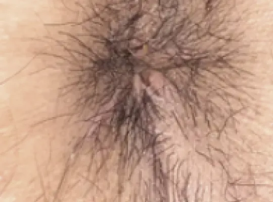 手術後1週間の症例写真