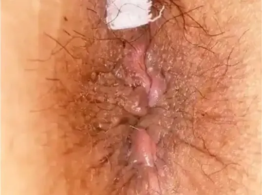 手術後1週間の症例写真