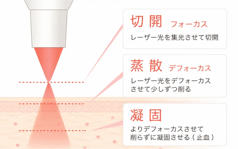 切開・蒸散・凝固のレーザー照射の使い分け図
