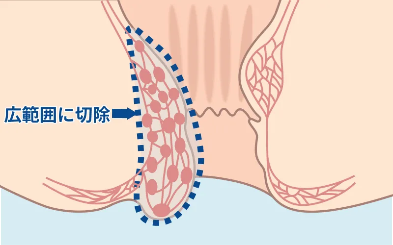 広範囲に切除する一般的な手術のイラスト