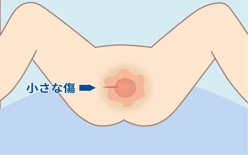 傷が小さく済むイラスト