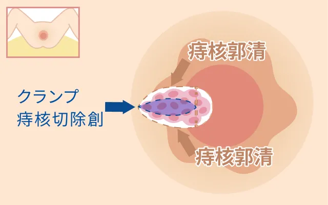 痔核の郭清のイラスト