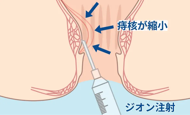 ジオン注射（ALTA）のイラスト