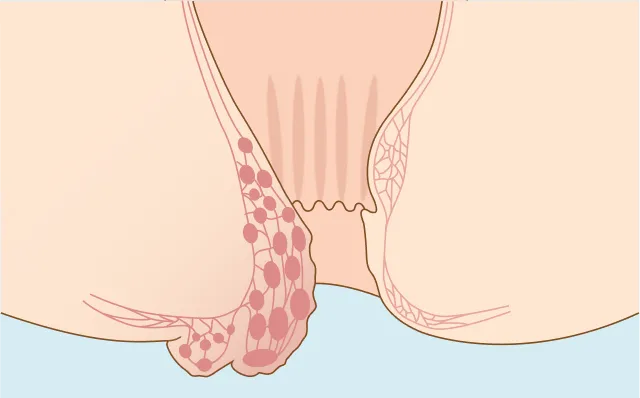 内痔核Ⅳ度のイラスト