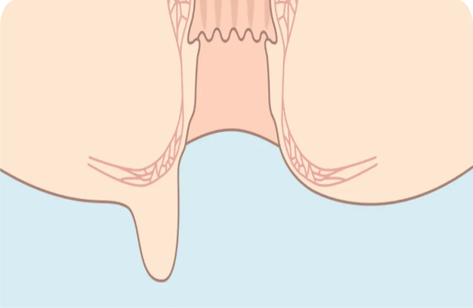 スキンタグ（肛門皮垂）の位置を示す断面イラスト
