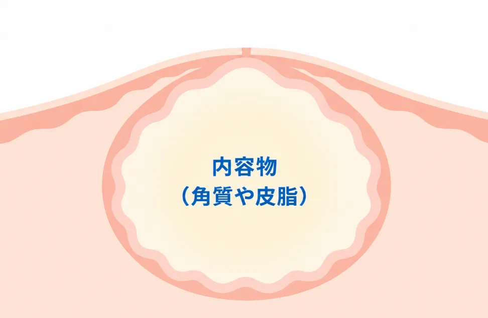 粉瘤（表皮嚢腫）の断面イラスト