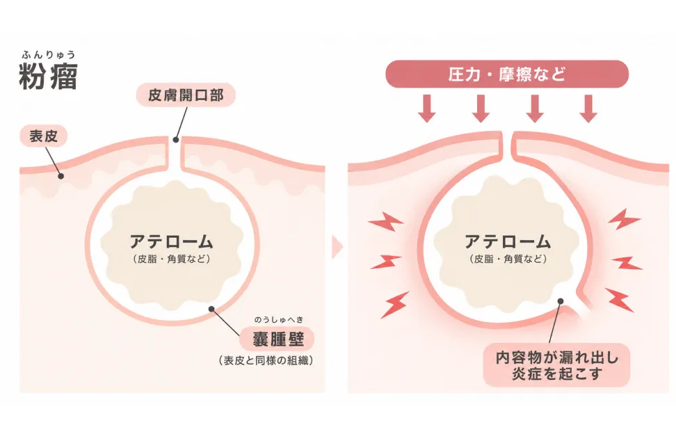 粉瘤ができる仕組みと炎症を起こした状態のイラスト
