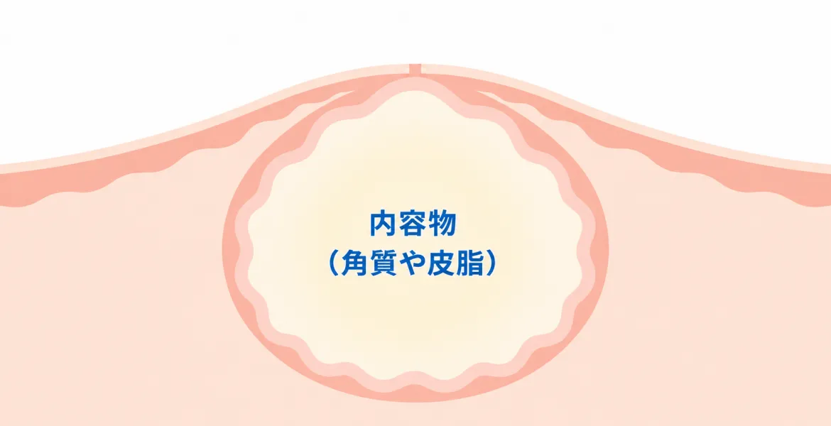 粉瘤（表皮嚢腫）の断面イラスト