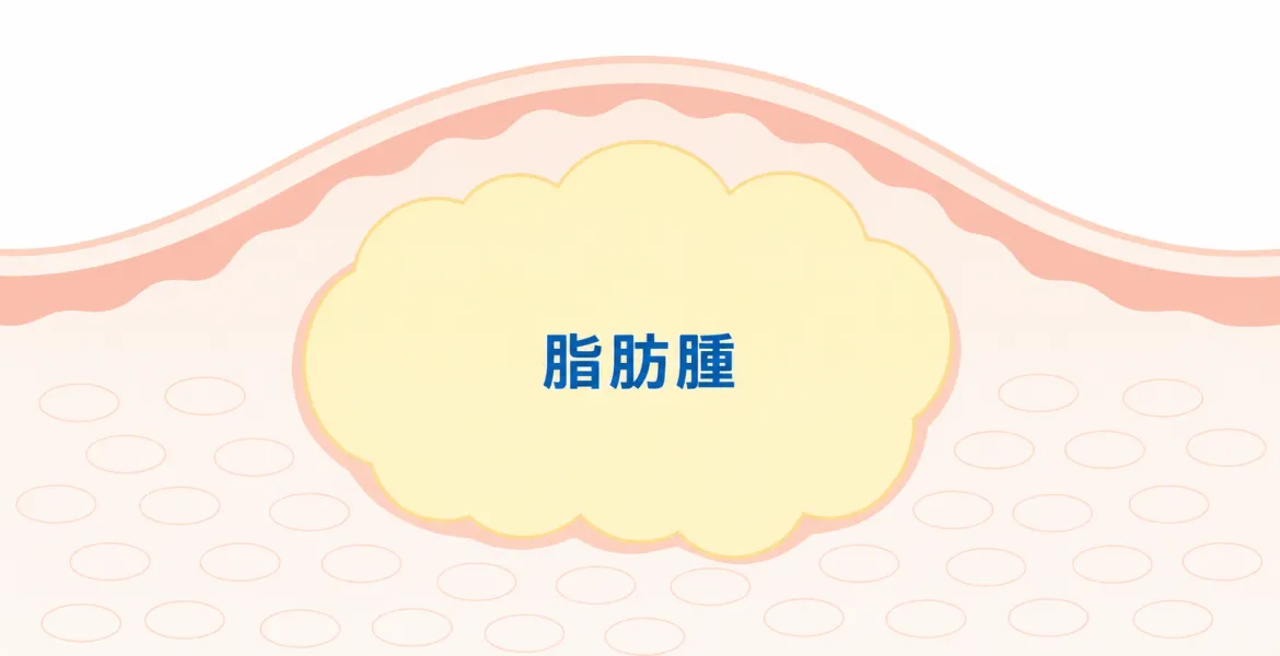 脂肪腫（リポーマ）の断面イラスト