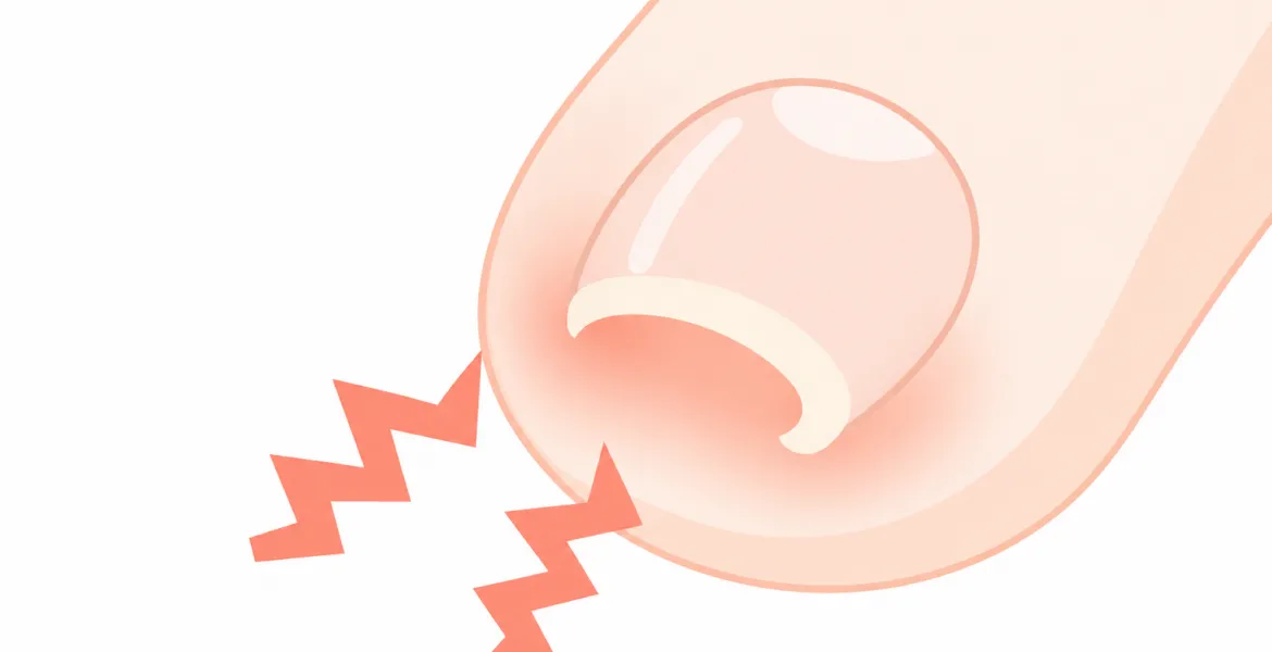 巻き爪（陥入爪）で痛みが出ている足の指のイラスト