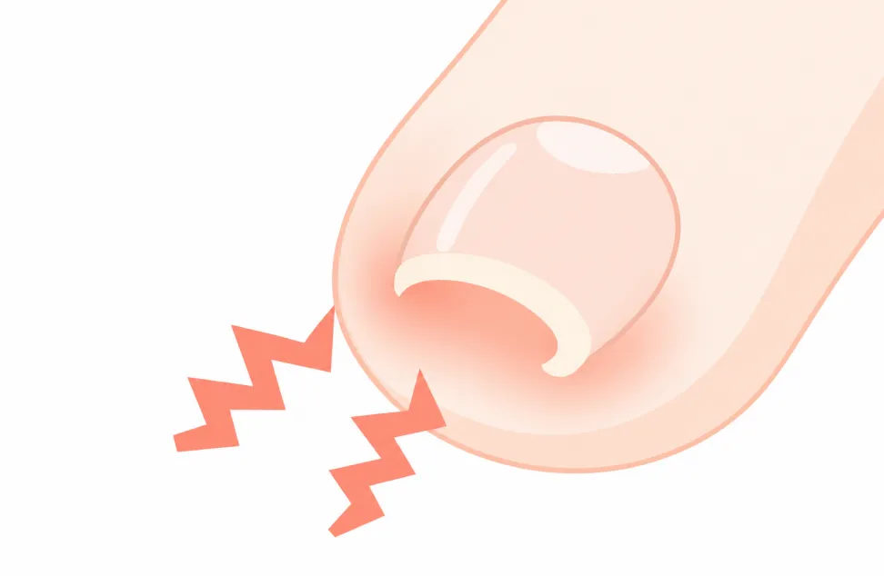 巻き爪（陥入爪）で爪の端が内側に巻き込んだ状態のイラスト