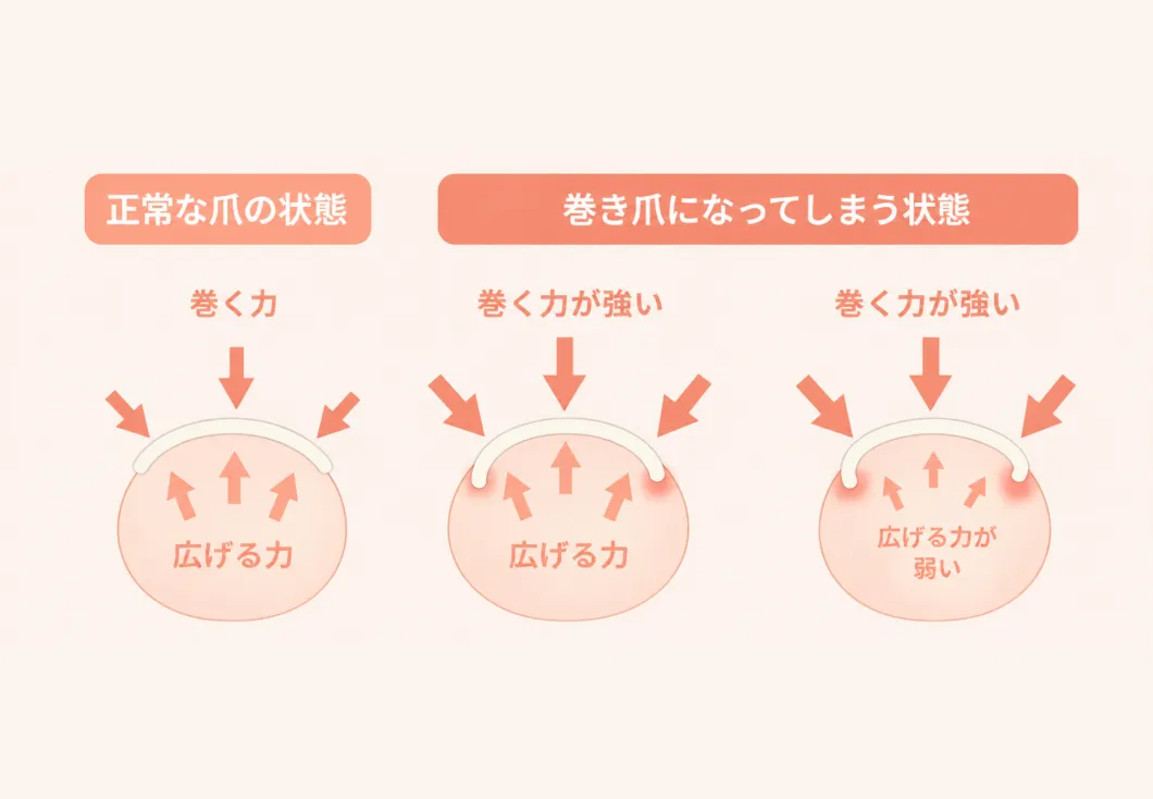 正常な爪と巻き爪になってしまう状態を比較したイラスト