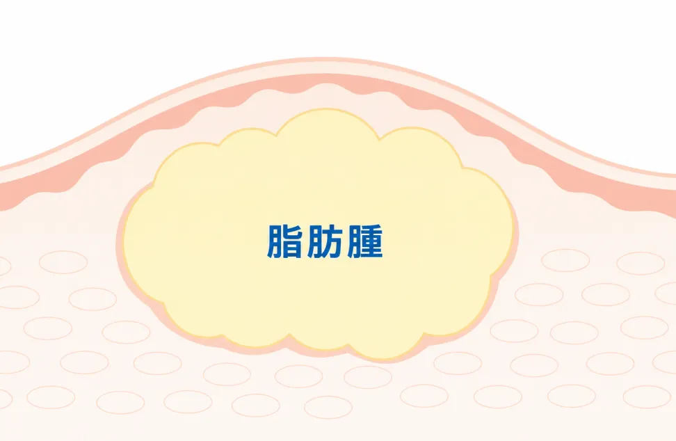 脂肪腫（リポーマ）の断面イラスト