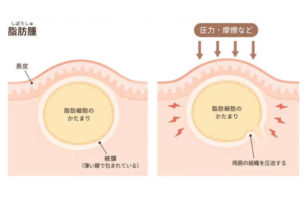 脂肪腫ができる仕組みのイラスト